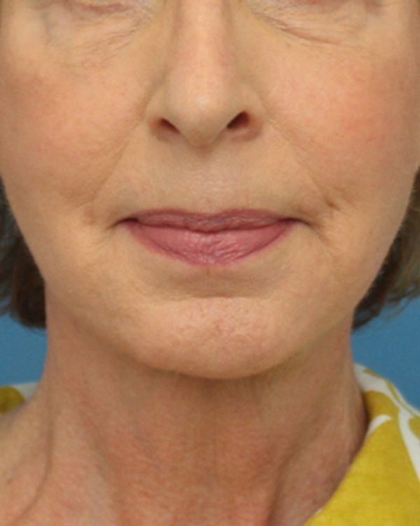 Facial Fat Transfer