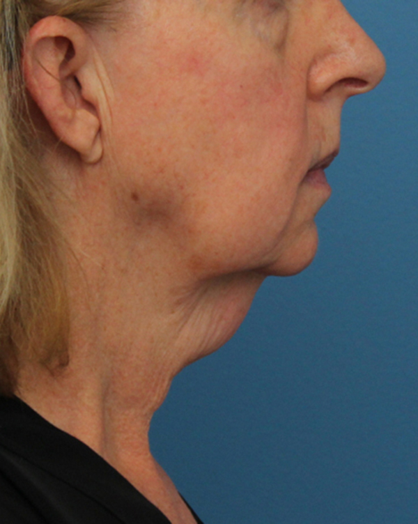 Face Lift/ Mini Lift/ Neck Lift