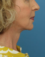 Face Lift/ Mini Lift/ Neck Lift