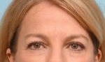 Brow Lift