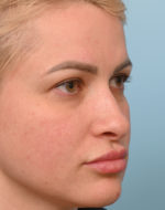 Rhinoplasty