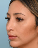 Rhinoplasty