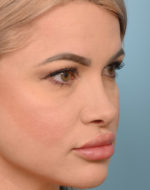 Rhinoplasty