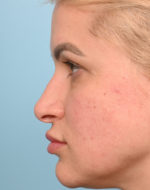 Rhinoplasty