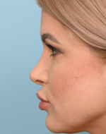 Rhinoplasty