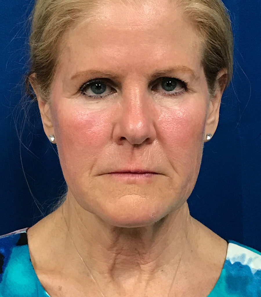 Face Lift/ Mini Lift/ Neck Lift