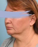 Facial Fat Transfer