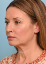 Face Lift/ Mini Lift/ Neck Lift