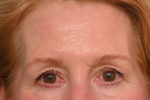 Brow Lift