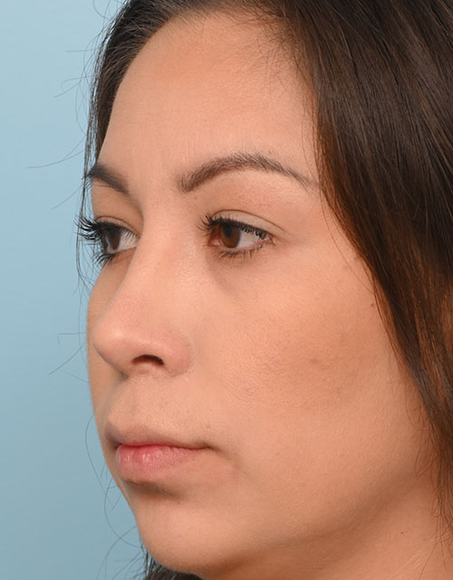 Rhinoplasty