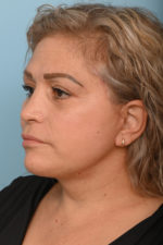 Face Lift/ Mini Lift/ Neck Lift