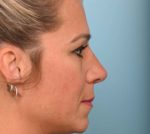 Rhinoplasty