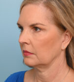 Face Lift/ Neck Lift