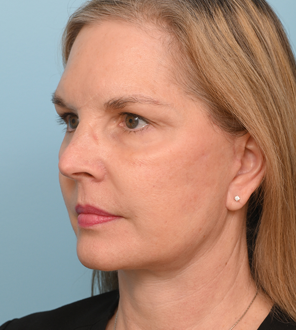 Face Lift/ Neck Lift