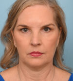 Face Lift/ Neck Lift