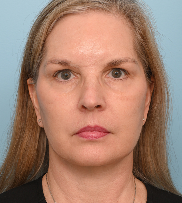 Face Lift/ Neck Lift