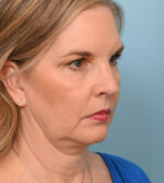 Face Lift/ Neck Lift