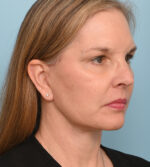 Face Lift/ Neck Lift