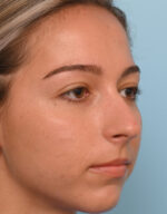 Rhinoplasty