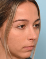 Rhinoplasty