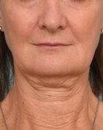 Face Lift/ Mini Lift/ Neck Lift