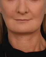 Face Lift/ Mini Lift/ Neck Lift