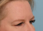 Brow Lift