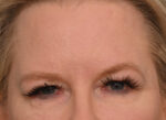 Brow Lift