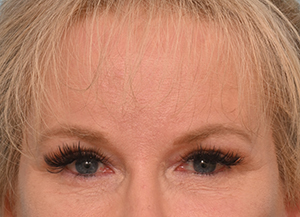 Brow Lift