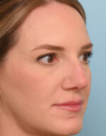 Rhinoplasty