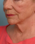 Face Lift/ Mini Lift/ Neck Lift