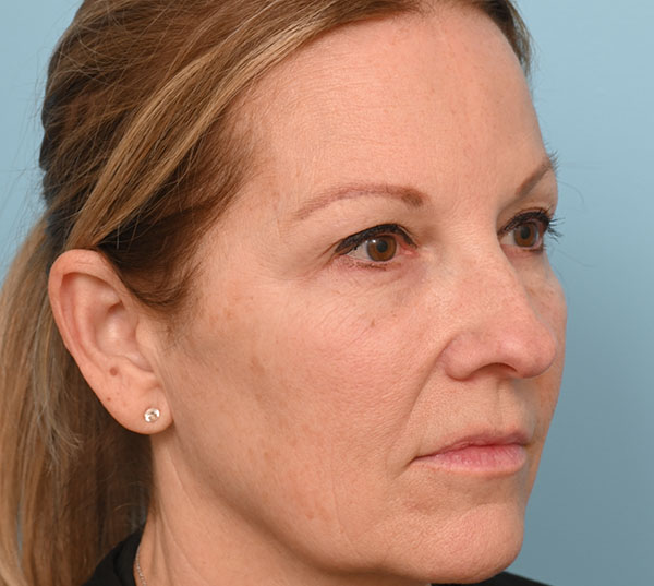 Rhinoplasty