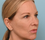 Rhinoplasty