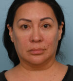 Face Lift/ Neck Lift
