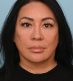 Face Lift/ Neck Lift