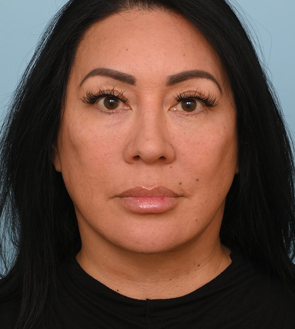 Face Lift/ Mini Lift/ Neck Lift
