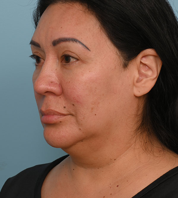 Face Lift/ Neck Lift