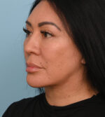 Face Lift/ Neck Lift