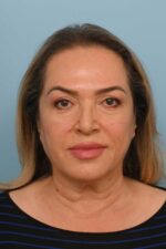 Face Lift/ Neck Lift