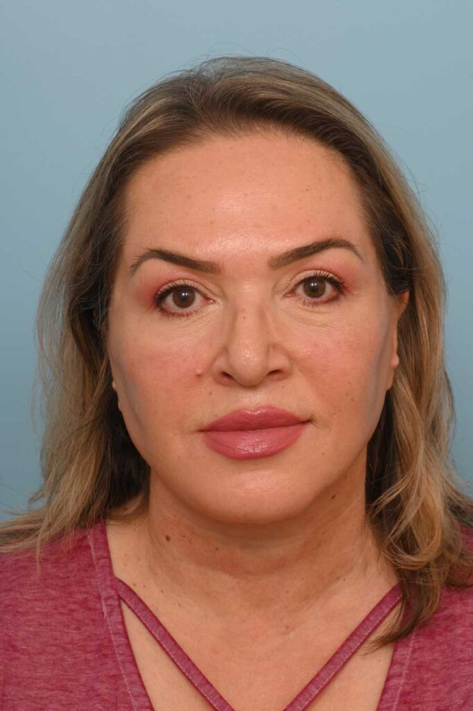 Face Lift/ Neck Lift