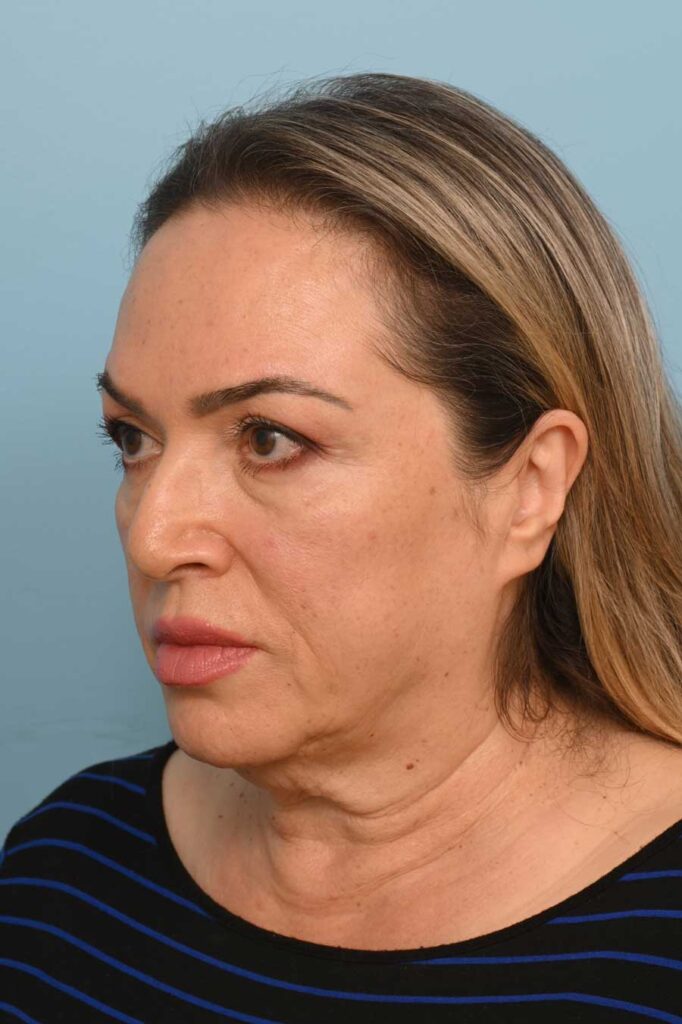 Face Lift/ Neck Lift