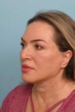 Face Lift/ Neck Lift