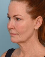 Face Lift/ Neck Lift