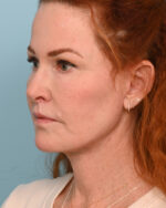 Face Lift/ Neck Lift