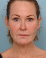 Face Lift/ Neck Lift