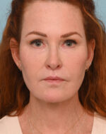 Face Lift/ Neck Lift