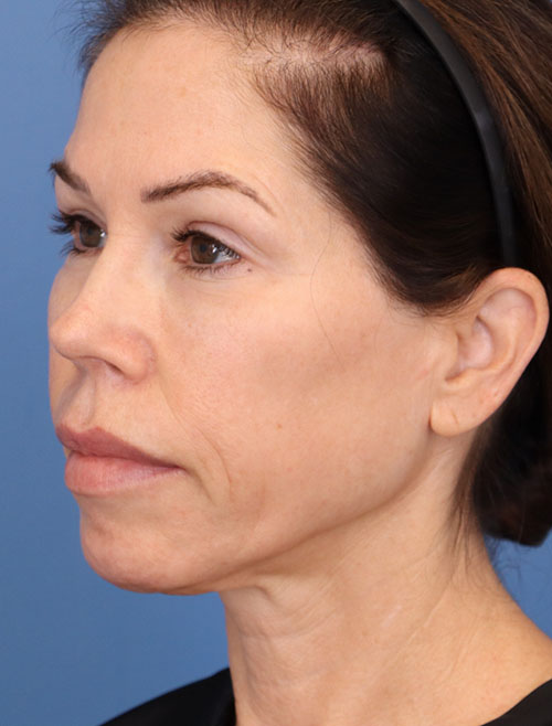 Face Lift/ Mini Lift/ Neck Lift