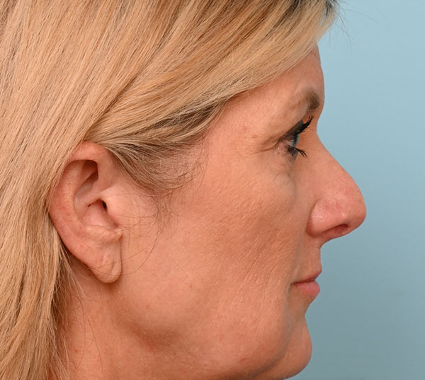 Rhinoplasty