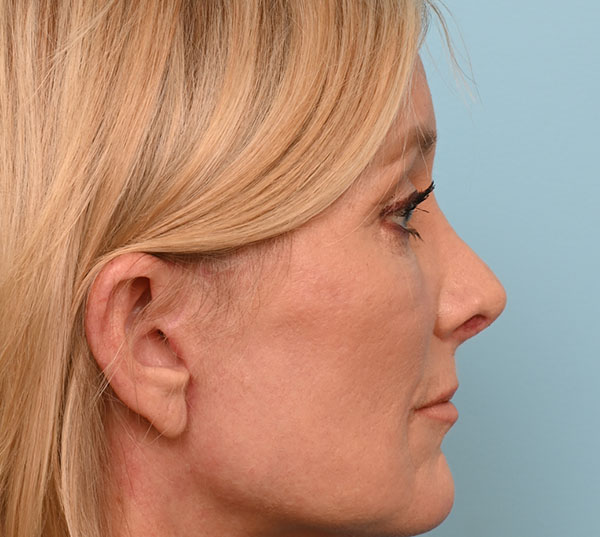 Rhinoplasty