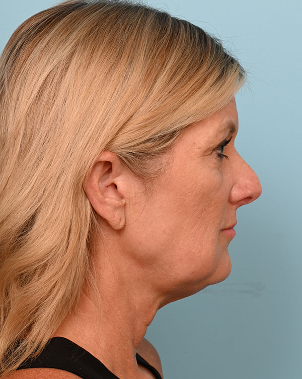 Facial Fat Transfer